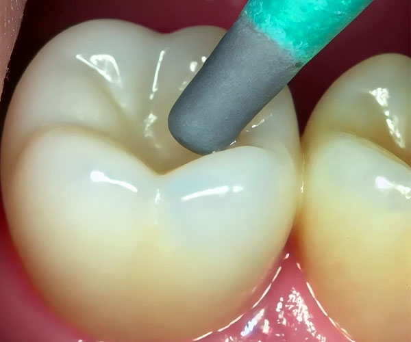 An image of a dentist carefully placing a dental crown on a patient’s prepared tooth, demonstrating the precision involved in the process.